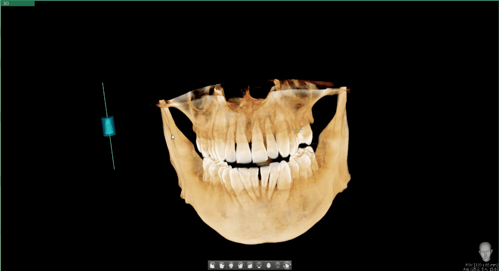 CBCT - One or Both Arches
