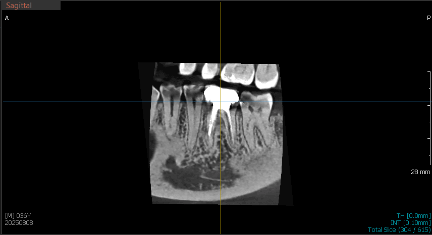CBCT - Limited Field of View