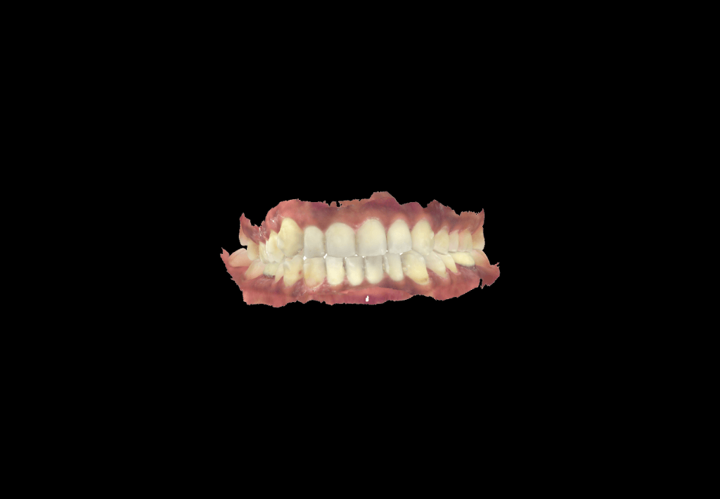 Digital Intraoral Impressions